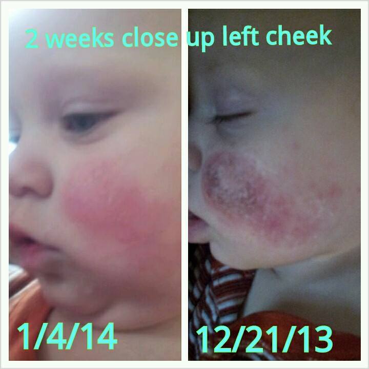 Can facial for eczema pity, that Rather facial for eczema suggest you